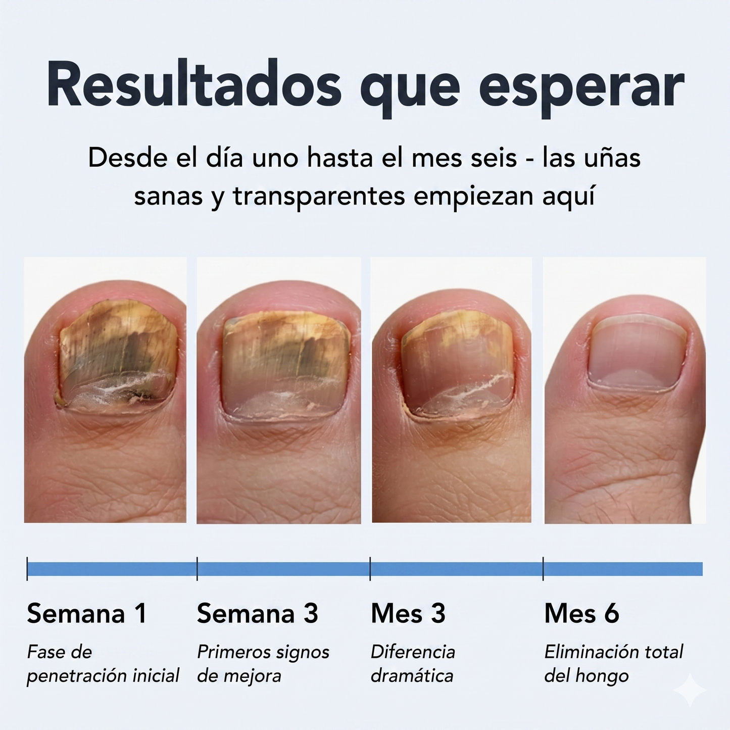 Lápiz Antifúngico UÑAsana™- Elimina la micosis de uñas desde la raíz