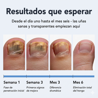 Lápiz Antifúngico UÑAsana™- Elimina la micosis de uñas desde la raíz
