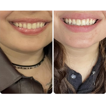 SmartWhite Pro I Dientes Blancos en 30 min
