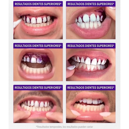 SmartWhite Pro I Dientes Blancos en 30 min